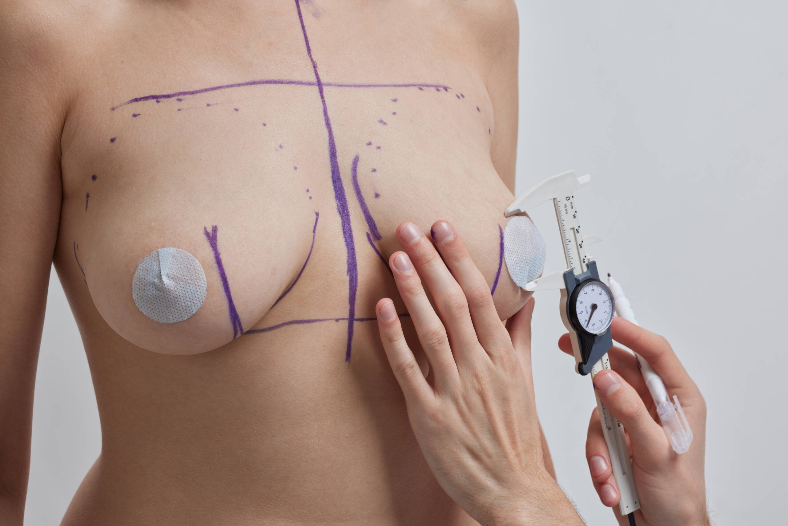 Nipple Correction / Inversion Correction Surgery