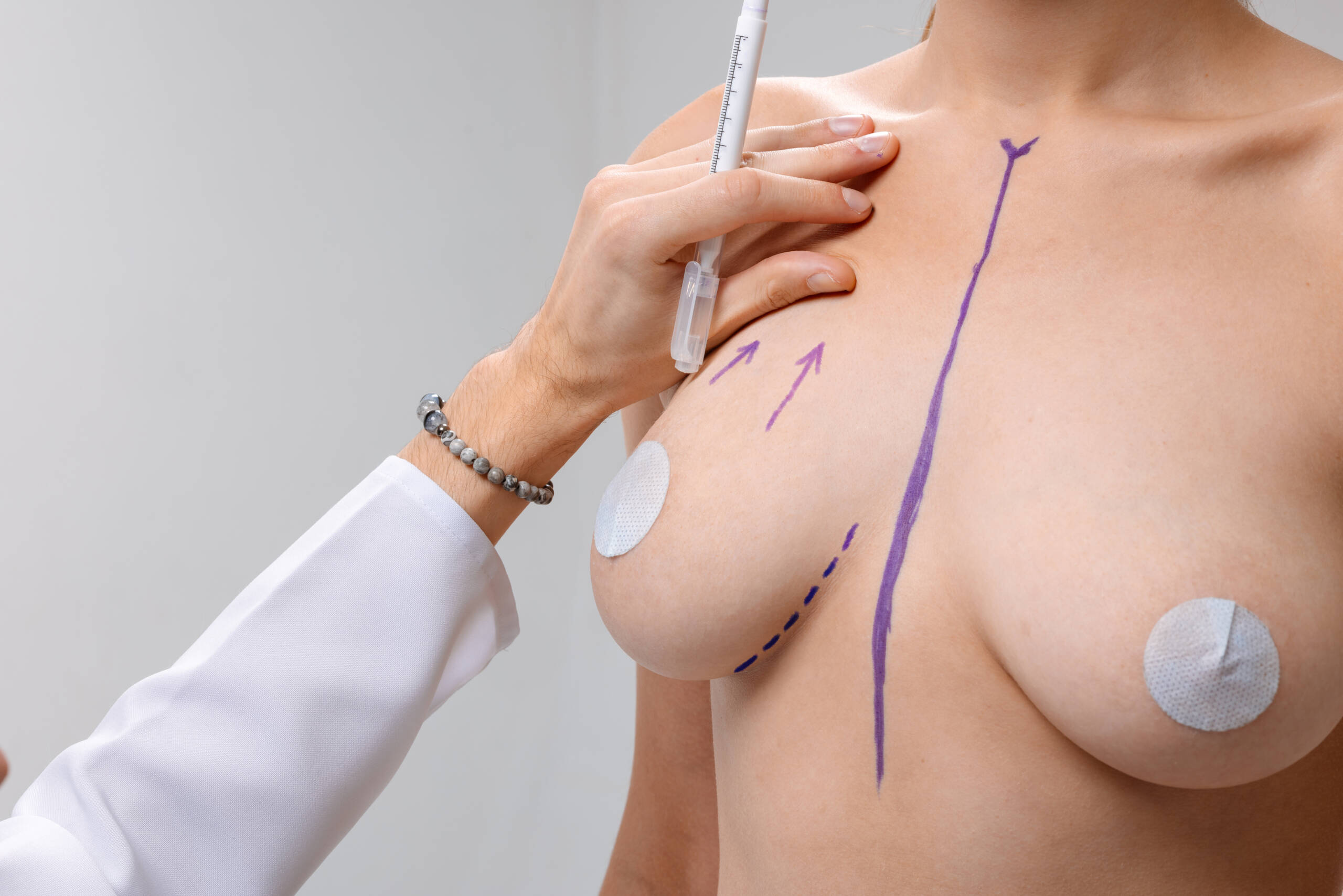Breast Lift (Mastopexy)